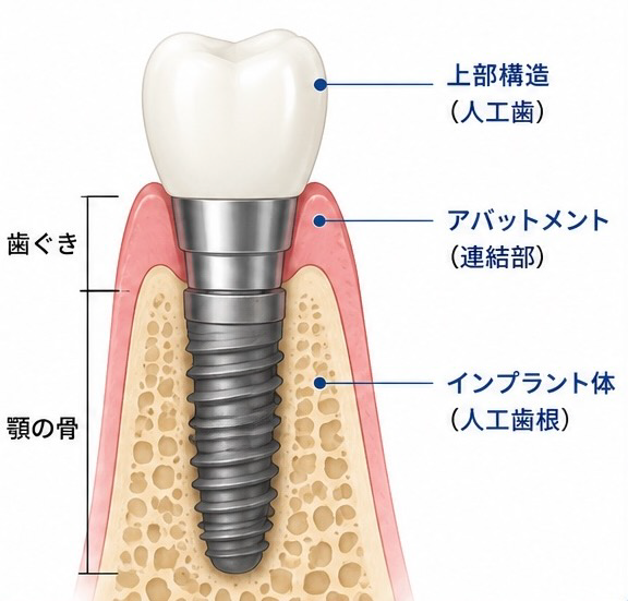 インプラントについての写真(愛知県豊明市)